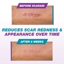 silicone-scar-gel-for-scars-after-surger-5.jpg